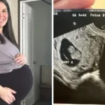 Mulher nasceu com 2 úteros e agora está grávida de ambos – é uma probabilidade de 1 em 50 milhões